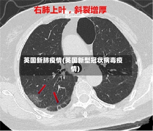 英国新肺疫情(英国新型冠状病毒疫情)-第2张图片